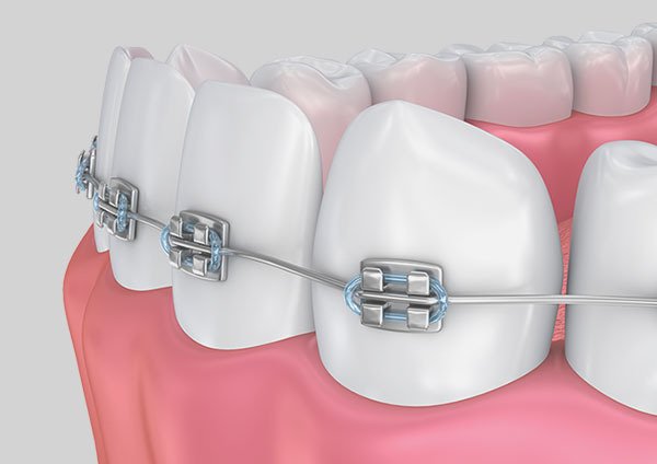 orthodontic care in west st paul mn